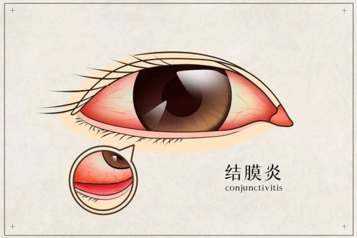 红眼病什么样子的图片图片